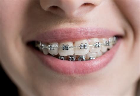 ventajas y desventajas de los brackets metalicos|que son brackets metalicos.